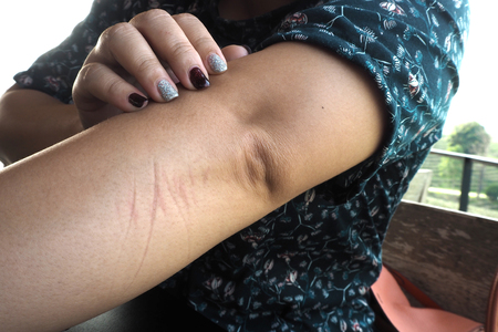 Little girl hurt her arm and her elbowの写真素材