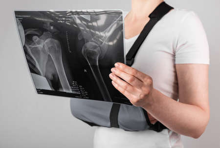 Woman wearing arm sling and looking at X-ray image. Female suffering from shoulder, clavicle, acromion fracture, strain. Health care, injury diagnostics concept. High quality photoの写真素材