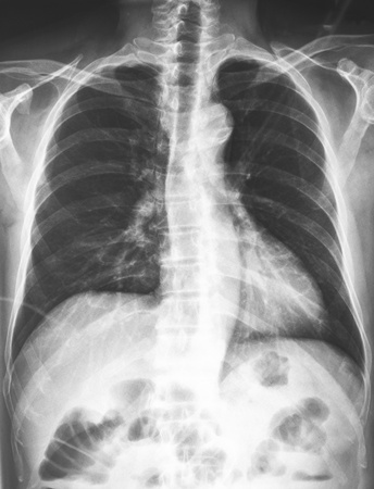 X-ray of the chestの写真素材