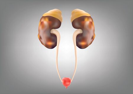 Human Kidney presents a medical concept as a organ that has the formation of painful minerals as a medical symbol with visual elements.の写真素材