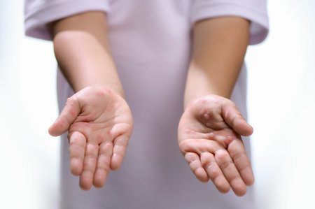 Hand, foot and mouth disease HFMD Human hand of scarlet fever in coxsackievirus palmarosa virus and child hand on white backgroundの写真素材