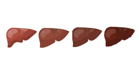Stages of human liver destruction cartoon illustration set. Person having liver disease or cancer. Internal organ isolated on white background. Biology, health conceptのイラスト素材