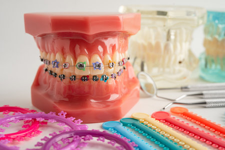 Orthodontic ligatures rings and ties, elastic rubber bands on orthodontic braces, model for dentist...