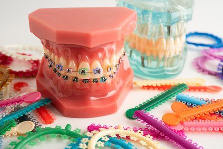 Orthodontic ligatures rings and ties, elastic rubber bands on orthodontic braces, model for dentist...