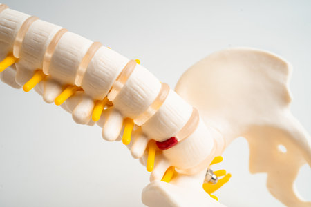 Spinal nerve and bone, Lumbar spine displaced herniated disc fragment, Model for treatment medical...