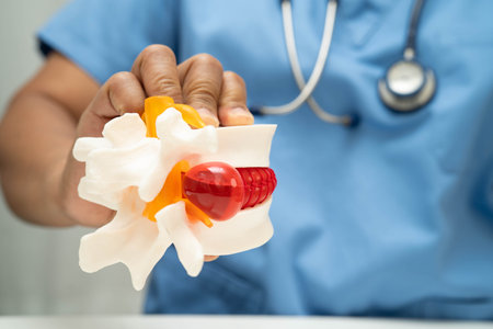Asian doctor holding spinal nerve and bone model, Lumbar spine displaced herniated disc fragment for treatment medical in the orthopedic department.の写真素材