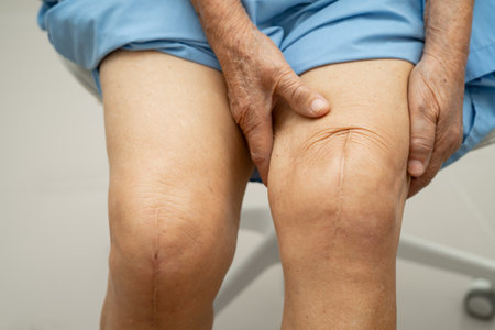 Asian elderly woman patient with scar knee replacement surgery in hospital.