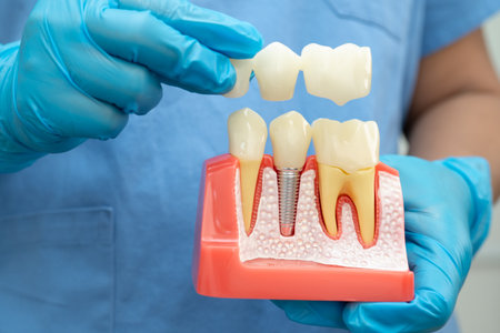 Dental implant, artificial tooth roots into jaw, root canal of dental treatment, gum disease, teeth...
