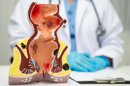 Asian doctor with rectum and hemorrhoid human anatomy model at hospital, inflamed vascular...