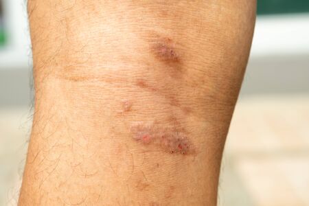 Closeup image of a male body suffering from chronic skin rash. Food allergy rash.の写真素材
