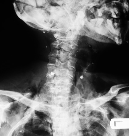 X-ray image of broken C-spine, AP view, the man hit by a truck