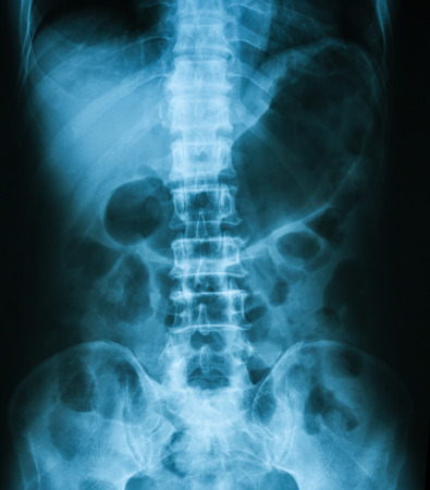 X-ray image of Abdomen supine position.の写真素材
