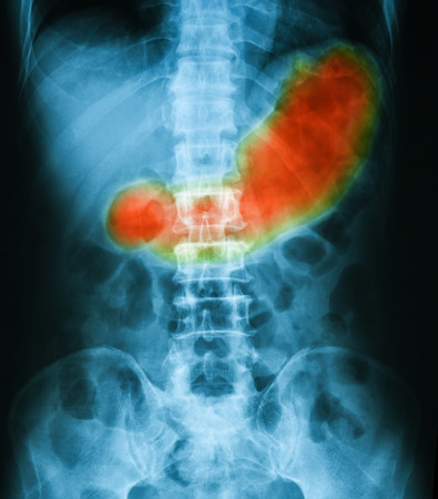 X-ray image of Abdomen supine position, show gastric juice and stomach or gastric ulcer.の写真素材