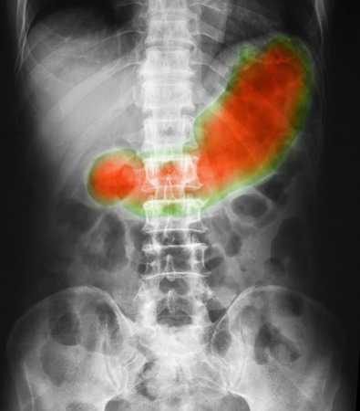X-ray image of Abdomen supine position, show gastric juice and stomach or gastric ulcer.の写真素材
