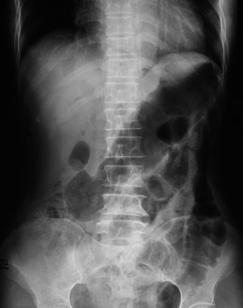 X-ray image of plain abdomen, supine position.の写真素材