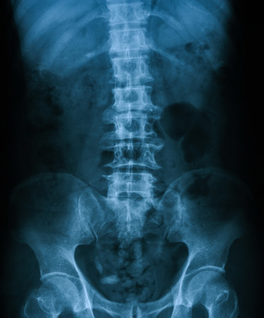 Xrayimag of KUB kidney ureter and bladder. Shows bladder stone.の写真素材