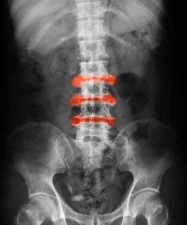 of Lumbosacral LS spine AP view show ankylosing spondylitis lumbarの写真素材