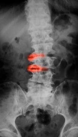 of Lumbosacral LS spine AP view show ankylosing spondylitis lumbarの写真素材