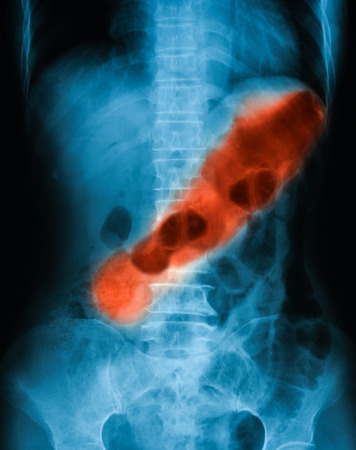 Xray image of plan abdomen supine position. shows gastric ulcer.の写真素材