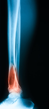 Broken leg x-ray image, lateral view, Showing tibia fracture.の写真素材