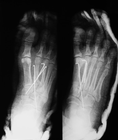 X-ray image of foot, AP and oblique view, showing the second metatarsal fracture after fixing with metal pins and plaster cast.の写真素材