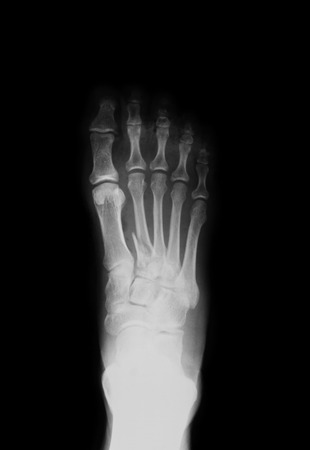 X-ray image of foot-the first matatarsal fracture, AP view, Shows the second matatarsal fracture.の写真素材