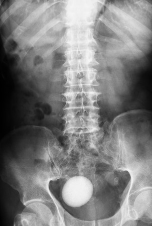 X-ray image of plain KUB, AP view, Showing a large bladder stone.