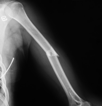 x-ray image of humerus, lateral view. Shows humerus fracture.の写真素材
