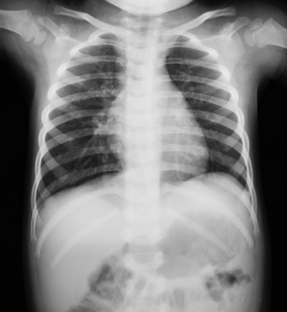 Chest x-ray image.の写真素材