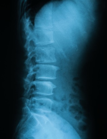 X-ray image of L-S spine lateral view.