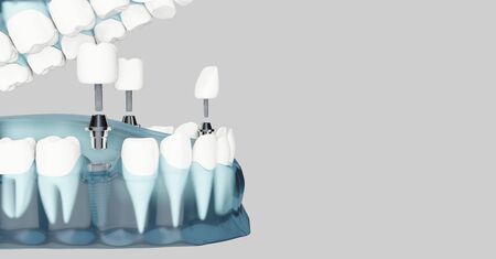 Component of Dental implants and copy space. Blue color transparent. 3d illustrations