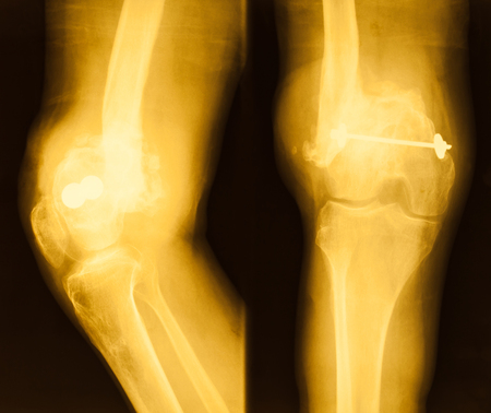 film X-ray image of Kneeの写真素材