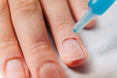 Manicure process. Cuticle on the fingernail. Treating the nail with an antiseptic for healing and...