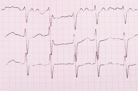 The tape with the cardiogram of man