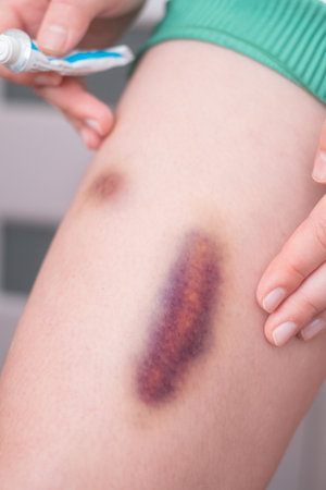 A large number of bruises on legs, skin in need of care and recovery. Woman applying cream to bruises for healing.の写真素材