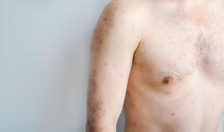 Man with sudden rash large blisters and redness on body typical hives outbreak caused by stress or food allergyの写真素材