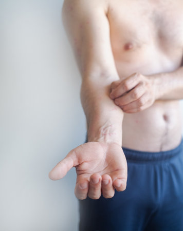 Man with red itchy rash over body from acute allergic reaction showing inflamed spots and skin...