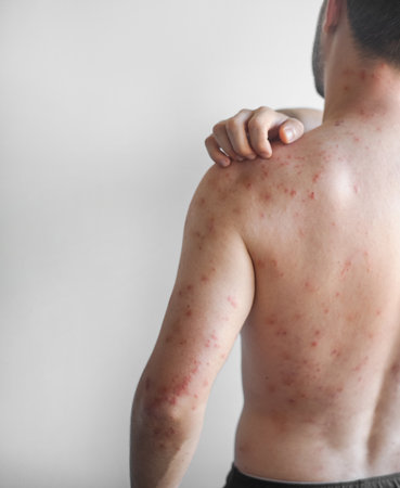 Red itchy scaly patches on a mans chest back and shoulders showing chronic skin irritation and discomfort in video.の写真素材