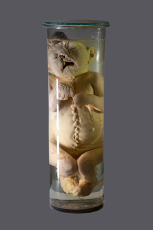 April 1, 2023. Belarus, Minsk. Exhibition of anatomical exhibits. Human infant with pathological development of cleft lip, cleft palate.のeditorial素材