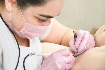 Removal of hair permanently in a womans armpits using electrolysis.の写真素材