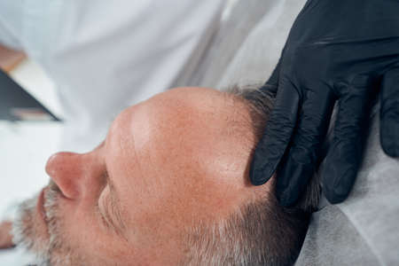 Doctor hand examining man hair in cosmetology clinicの写真素材