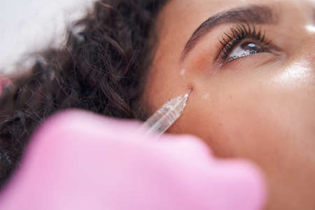 Syringe needle penetrates under the skin under the eye along pre-marked contours