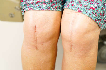 Asian elderly woman patient with scar knee replacement surgery in hospital.の写真素材