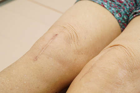 Asian elderly woman patient with scar knee replacement surgery in hospital.の写真素材