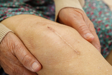 Asian elderly woman patient with scar knee replacement surgery in hospital.の写真素材