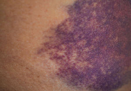 Bruise on the buttock skin injury from accident at home.の写真素材