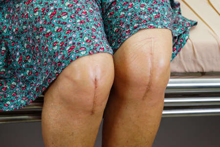 Asian elderly woman patient with scar knee replacement surgery in hospital.の写真素材