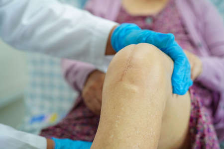 Doctor checking Asian elderly woman patient with scar knee replacement surgery in hospital.の写真素材