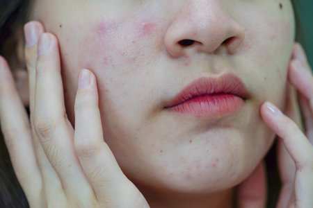 Acne pimple and scar on skin face, disorders of sebaceous glands, teenage girl skincare beauty...