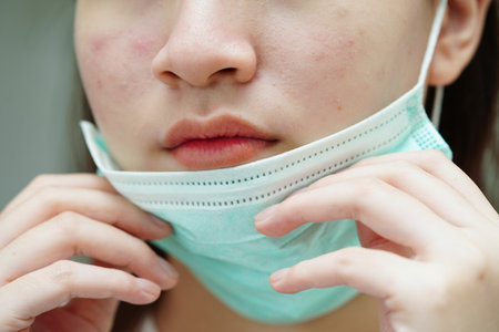 Acne pimple and scar on skin face, disorders of sebaceous glands, teenage girl skincare beauty...